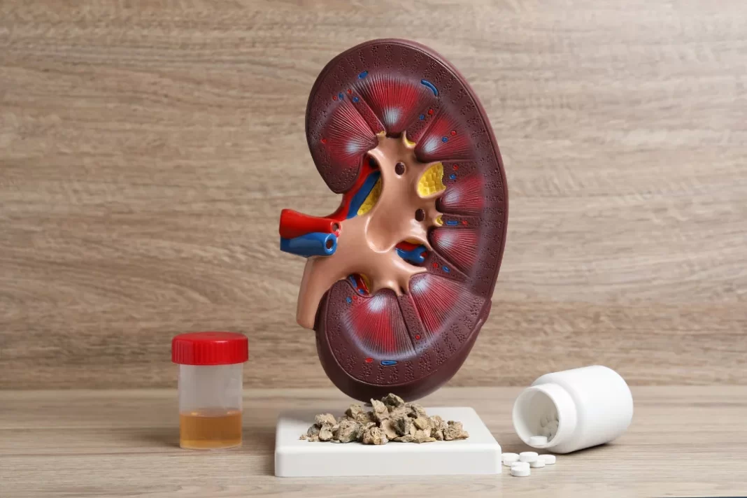 kidney stones and supplements
