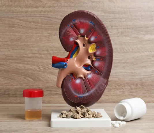 kidney stones and supplements