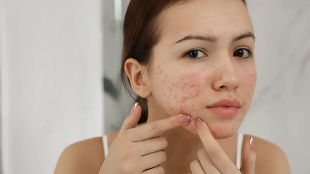 Girl having acne on her face. 