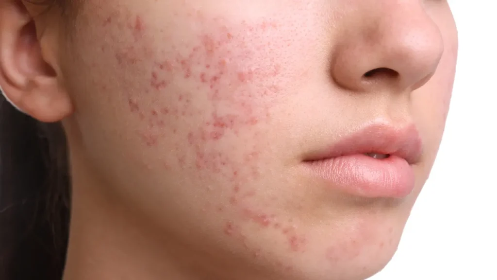 girl face with acne scars